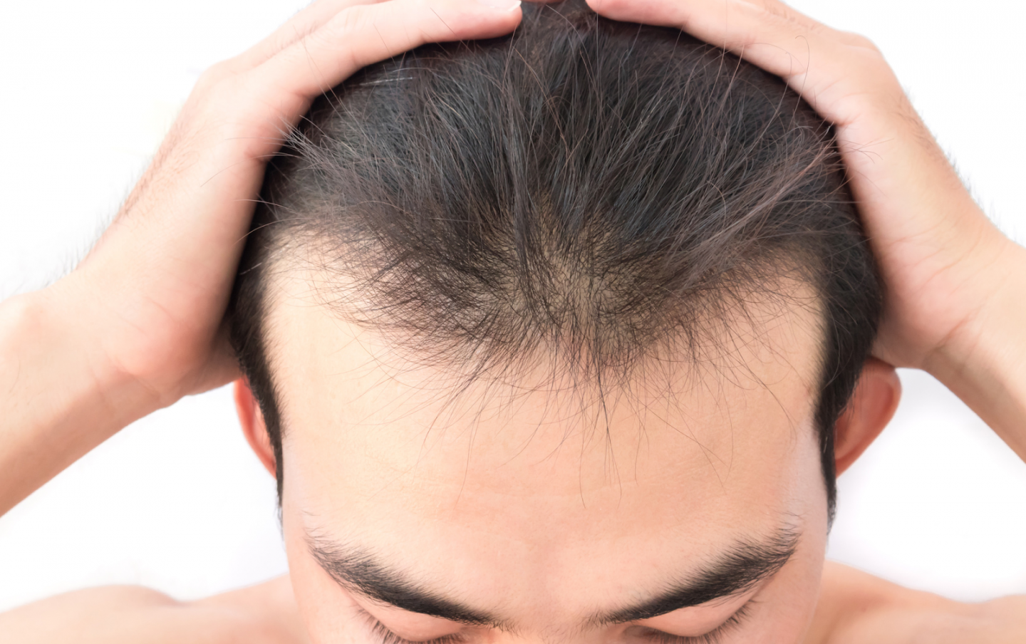 Hair Loss Doctor Santa Monica, CA - Hair Transplant Doctor Los Angeles