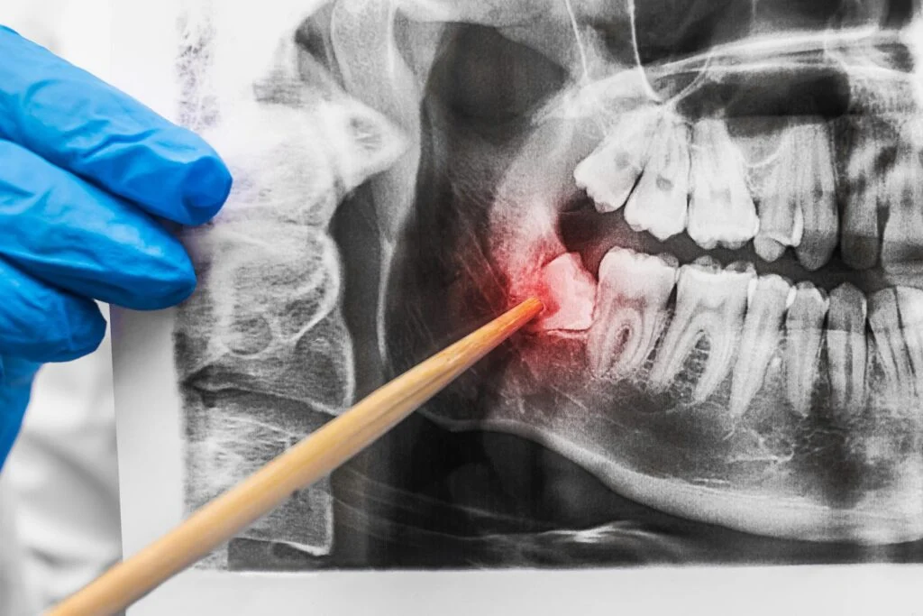 Surgical Insight: Navigating Wisdom Teeth Removal with Ease